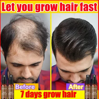 ג ' ינג ' ר צמיחת השיער ספריי מהיר לגדול נגד נשירת שיער שמן אתרי למנוע התקרחות טיפול פגום תיקון HairCare בריאות יופי