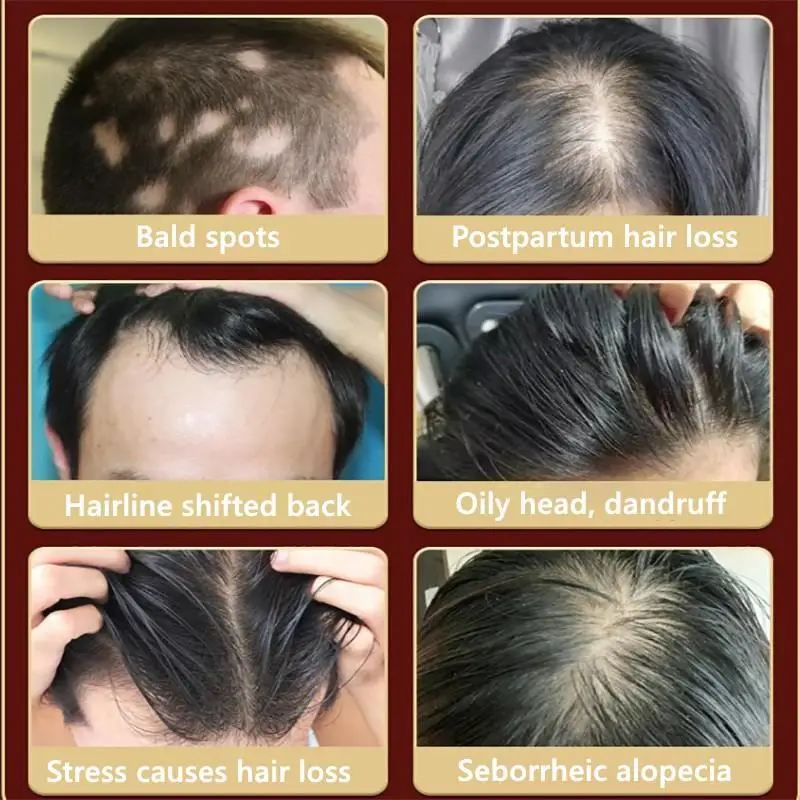 ג ' ינג ' ר צמיחת השיער ספריי מהיר לגדול נגד נשירת שיער שמן אתרי למנוע התקרחות טיפול פגום תיקון HairCare בריאות יופי - 1