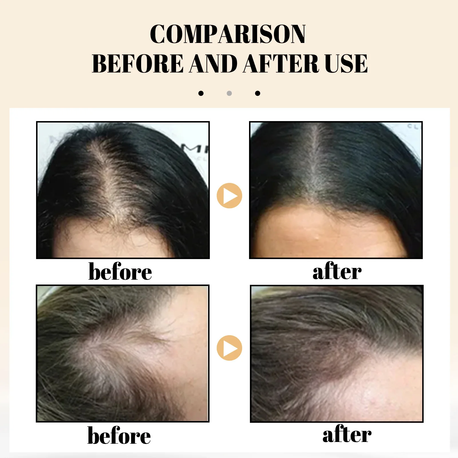 אורז נגד אובדן שמפו סבון להזין שיפור התקרחות לצמיחה מחודשת שיער הסרת קשקשים לחות השיער שמפו טיפולי - 2