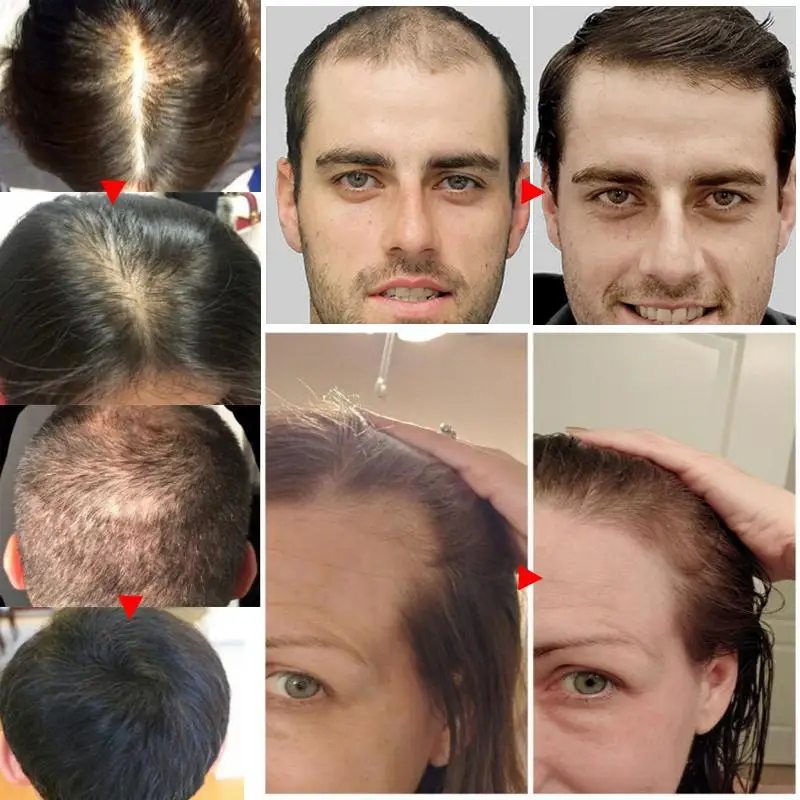 ג ' ינג ' ר צמיחת השיער ספריי מהיר לגדול נגד נשירת שיער שמן אתרי למנוע התקרחות טיפול פגום תיקון HairCare בריאות יופי - 2